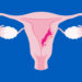 Prevén futuro alentador en terapias para cáncer de endometrio