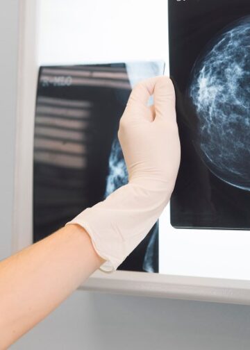 ALIA Health y ÜMA Tech IA desarrollan una plataforma de inteligencia artificial para anticipar la probabilidad futura de cáncer de mama