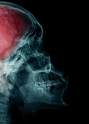 Brote “sin precedentes” de meningitis afecta a Reino Unido, reportan dos muertos